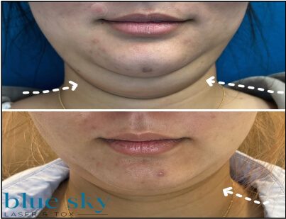 Double Chin Correction Treatment Before and After 2