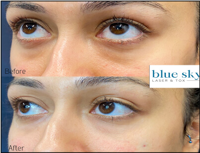 Eye Rejuvenation Treatment Before and After 1