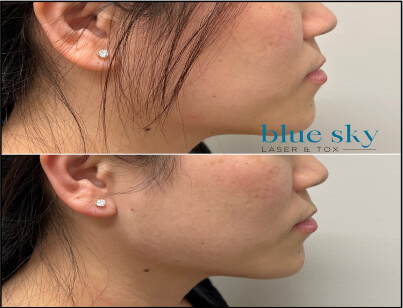 Jawline _ Chin Correction Treatment Before and After 4