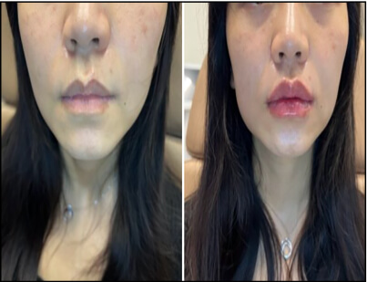Lip Enhancement Treatment Before and After 3