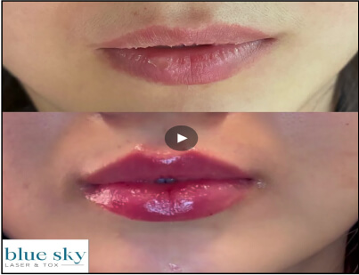 Lip Enhancement Treatment Before and After 5