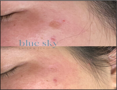 Spot Corrector Treatment Before and After 2